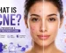 What Is Acne? The Complete Guide to Understanding and Treating Acne